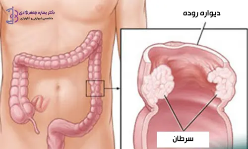 سرطان روده