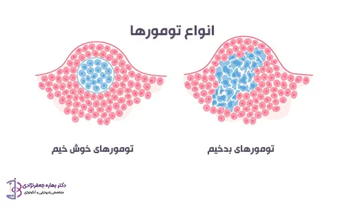 انواع تومورها