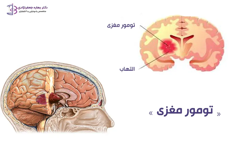 تومور مغزی