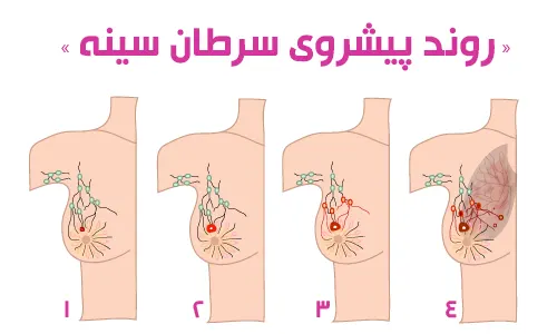 روند پیشروی سرطان سینه