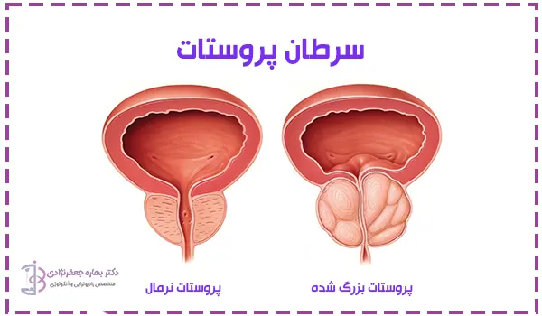 سرطان پروستات
