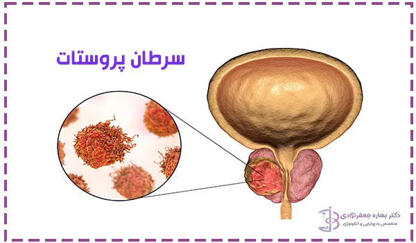 سرطان پروستات