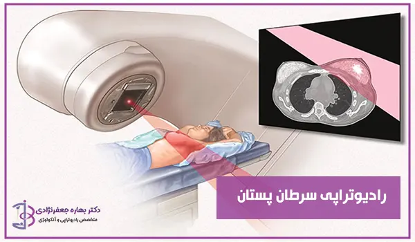 رادیوتراپی سرطان پستان