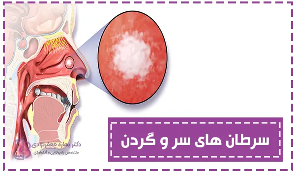 سرطان های سر و گردن