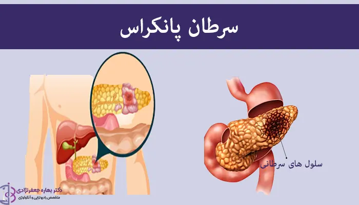 سرطان پانکراس 