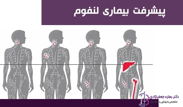 پیشرفت لنفوم