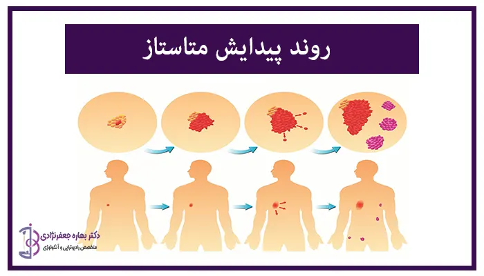 روند پیدایش متاستاز