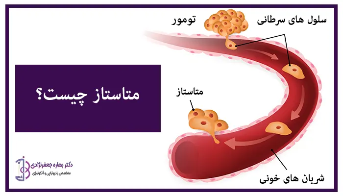 متاستاز چیست؟