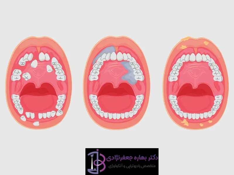 علائم سرطان دهان