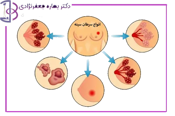 انواع سرطان سینه