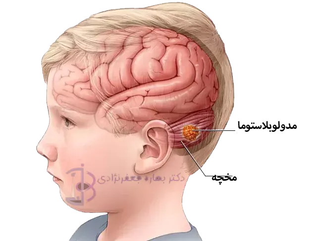 تومور مغزی مدولوبلاستوم