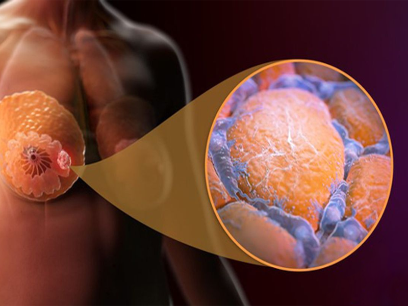 درمان سرطان سینه