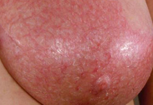 سرطان التهابی سینه