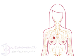 سرطان سینه