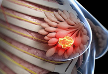 کارسینوم لوبار