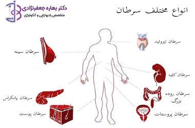 سرطان شرایطی است که طی آن سلول های بدن بیش از حد رشد و تقسیم می یابند به طوری که کنترل آن بدن را با مشکل مواجه می کند