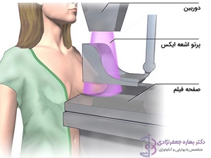 نحوه انجام ماموگرافی